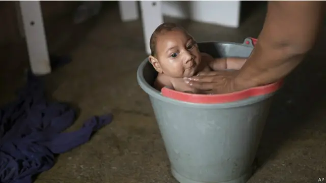 ज़िका से संक्रमित एक बच्चा.