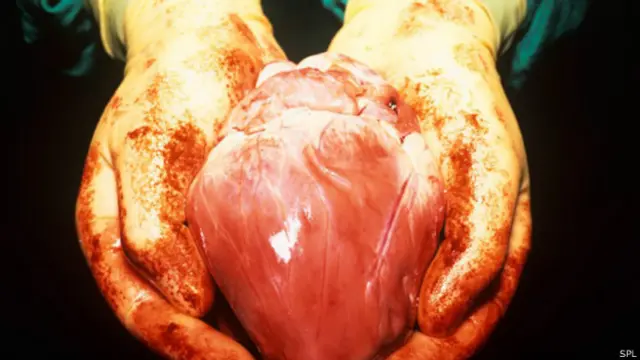 人類心臟移植(圖片來源:SPL)