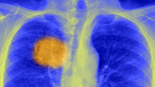 محققین کا خیال ہے کہ ان کی دریافت سرطان کے نئے علاج کے لیے کی جانے والی تحقیق میں ریڑھ کی ہڈی کی حیثیت رکھتی ہے 