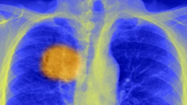 நோயெதிர்ப்புக் கட்டமைப்பை ஒழுங்கு படுத்தி புற்று நோயை அழிக்கும் முறைமை கண்டுபிடிக்கப்பட்டுள்ளது