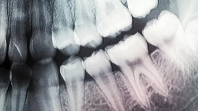 Una radiografía de una mandíbula