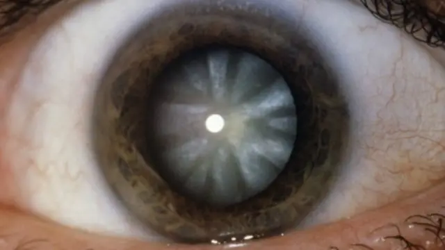 eye