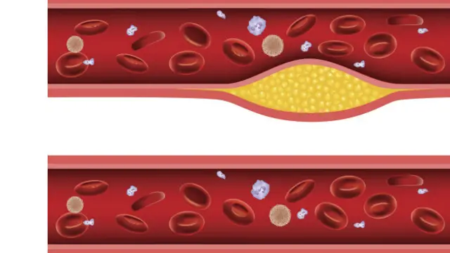 رسوب کلسترول در دیواره رگ