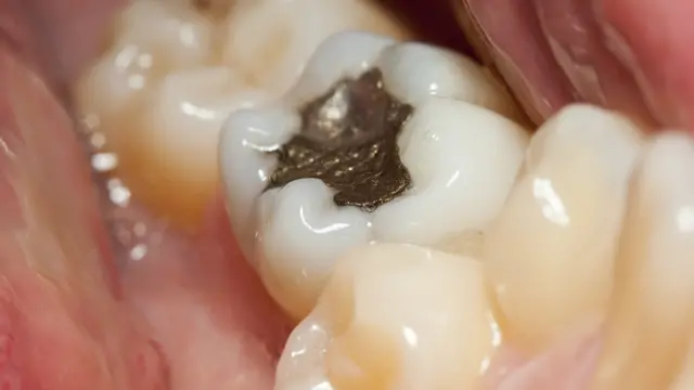 Зуб с пломбой