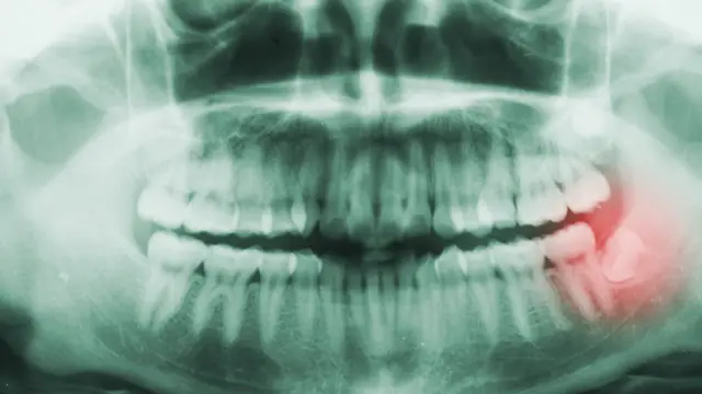 Рентгеновский снимок зубов