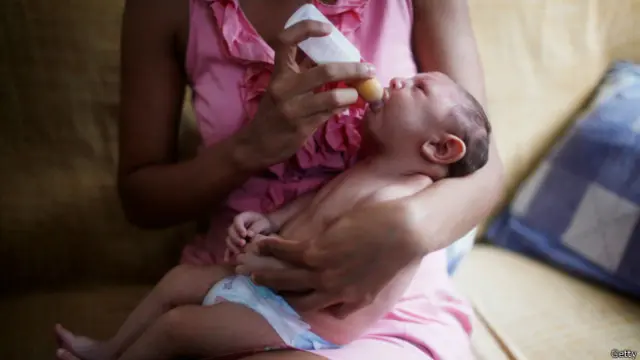 Un bebé con microcefalia