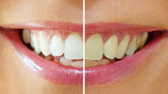 Blanqueamiento dental