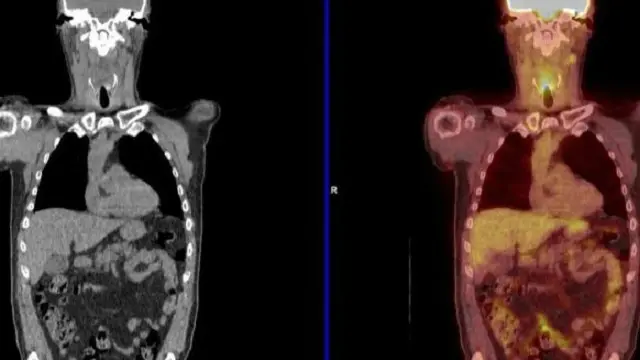 الصورة الملونة تظهر النقاط السرطانية، وإحداها في الحلق