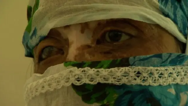 Кислотна атака спотворила обличчя Анупами