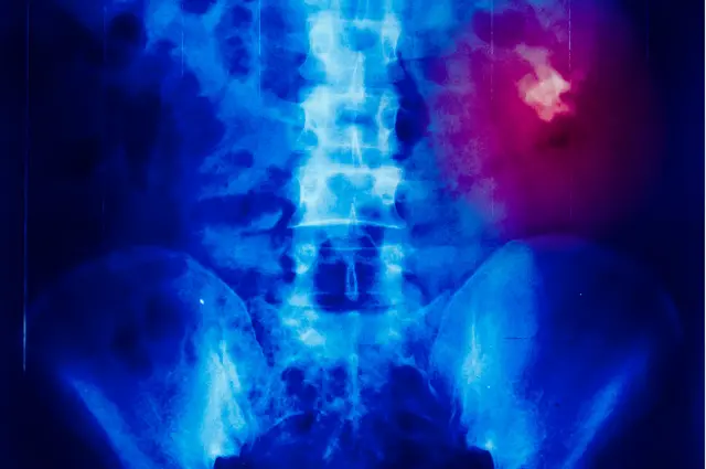 Los cálculos renales son apenas uno de los riesgos.