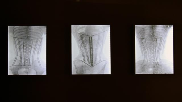 Рентгеновские снимки корсетов на теле