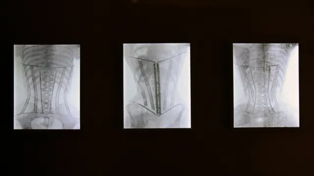 Korsetlərin rentgen fotoları.