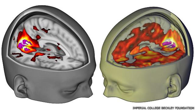 Escáner del cerebro de dos voluntarios, uno que recibió un placebo izq y otro LSD