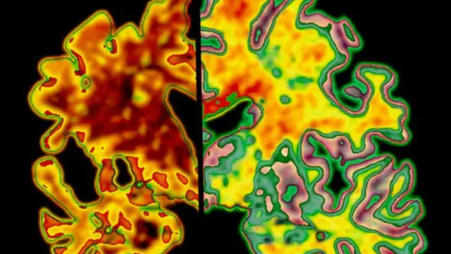 Terapi Baru Alzheimer Gunakan Imunoterapi dan Laser Otak