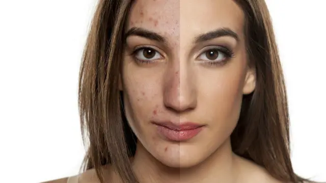 مہاسوں سے متاثرہ چہرے کی میک اپ اور فوٹو شاپ سے تبدیل شدہ پہلے اور بعد کی تصویر