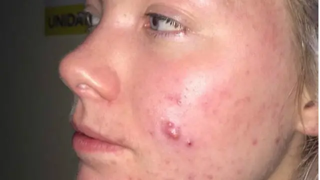 کیٹی کا کہنا ہے کہ یہ بتایا جانا چاہیے کہ مہاسے بھی کسی دوسری بیماری کی طرح ایک طبی مسئلہ ہے 