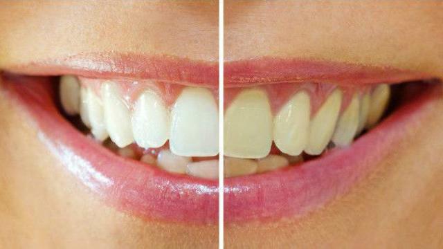 Желтые зубы — причины и способы отбелить пожелтевшую эмаль