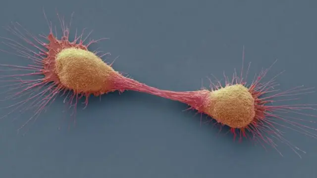 سرطان البروستاتا