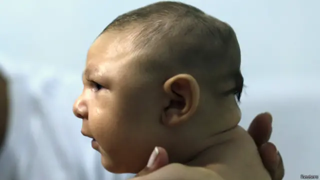 O vírus é associado a um boom nos casosgrêmio x csa palpitesmicrocefalia