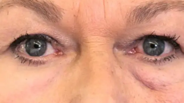 Jicho la kushoto limebandikwa Polymer, la kulia halikubandikwa