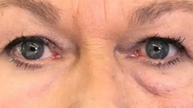 На кожу под глазом в левой части фотографии была нанесена пленка