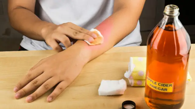 El vinagre de sidra de manzana también puede dejar tu piel irritada.