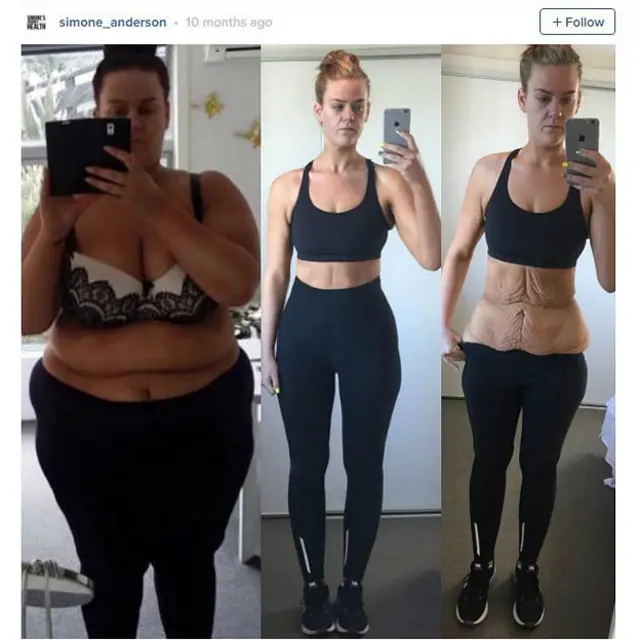 Anderson melakukan operasi untuk mengangkat stretch-mark di tubuhnya.