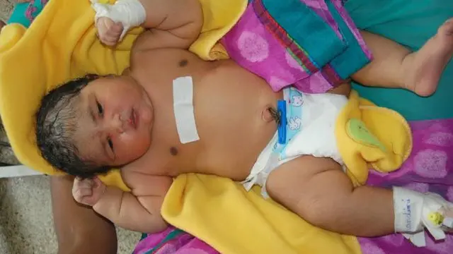 Bayi perempuan yang dilahirkan seorang Ibu bernama Nandini mencapai bobot 6,8 kg.
