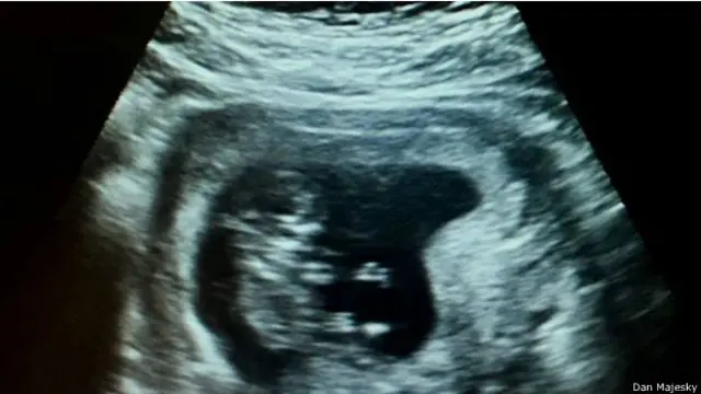 Majesky mengunggah foto janin yang tengah dikandung istrinya, Leah.