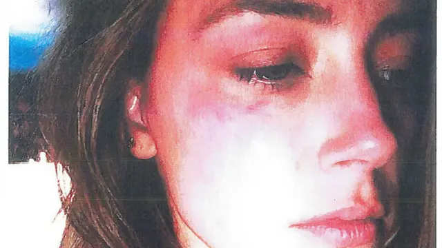 Amber Heard presentó en la justicia una foto con lesiones en un ojo.