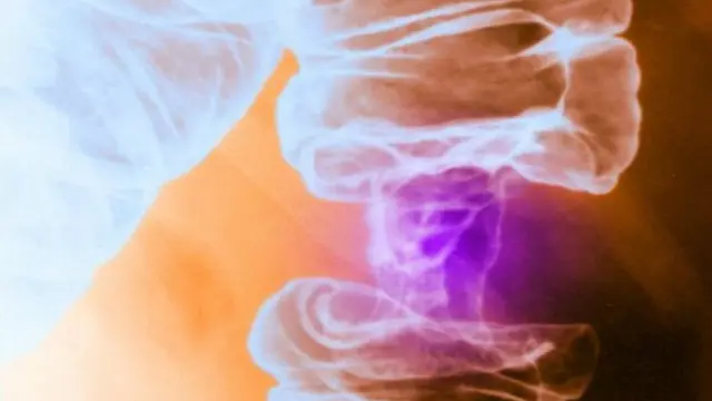 سرطان الأمعاء