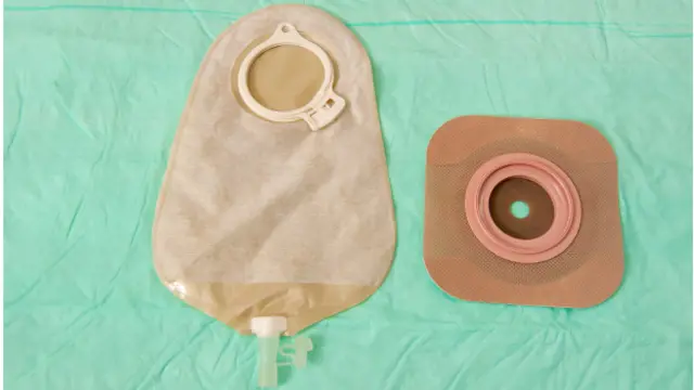 کیسه مدفوع (کولوستومی) 