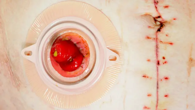 محل کولوستومی، سر روده دیده می‌شود