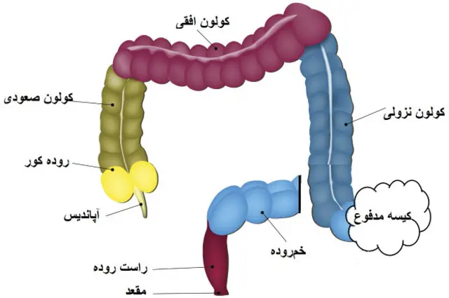 آناتومی روده بزرگ، جراح سر بالایی، قبل از محل انسداد را از شکم بیرون می‌گذارد تا کیسه مدفوع به آن متصل شود و سر پایینی، بعد از محل انسداد، را کور می‌کند