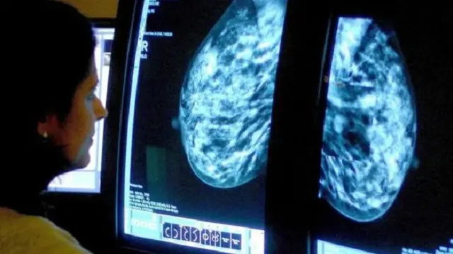 في بريطانيا يتم تشخيص أكثر من 40 ألف حالة بسرطان الثدي بسبب الأستروجين سنويا