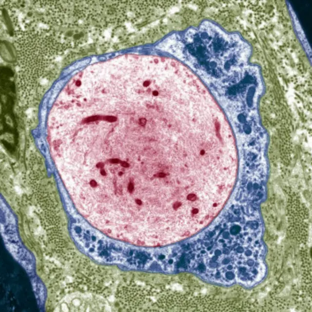 رشته عصب (آکسون) به رنگ قرمز که دور آن را سلول شوآن (سازنده میلین) به رنگ آبی گرفته اما چون فرد مبتلا به ام‌اس است خود میلین دور عصب وجود ندارد