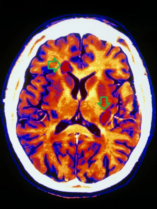 سی‌تی اسکن مغز فرد مبتلا به ام‌اس، جاهایی که اعصاب غلاف خود را از دست داده‌اند با فلش مشخص شده