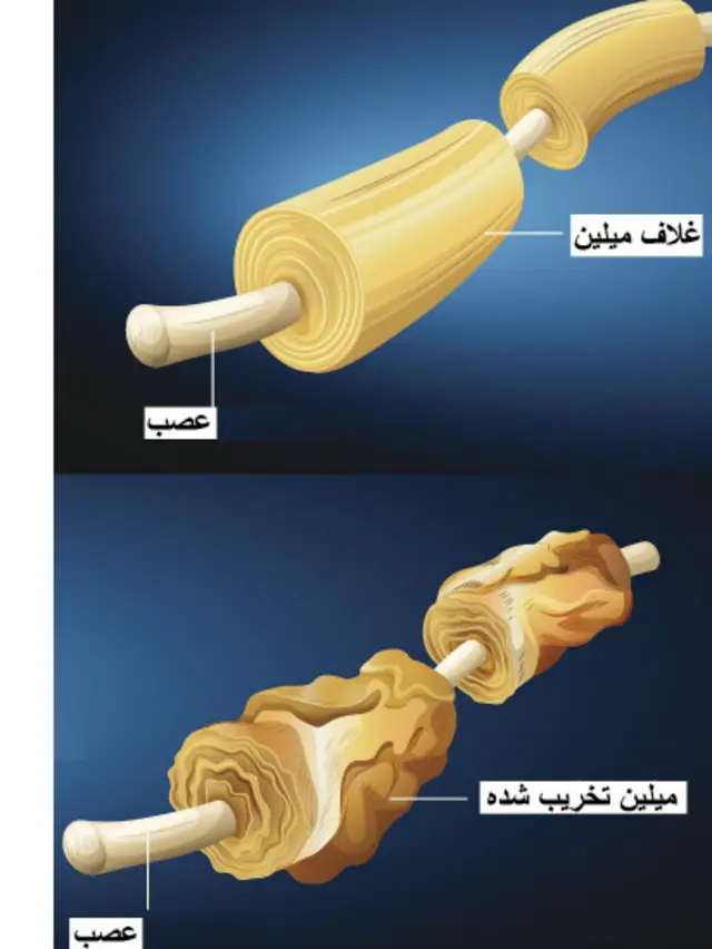 تخریب غلاف میلین در ام‌اس