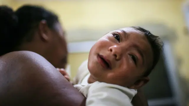 زيكا تسبب في ولادة أكثر من 1400 طفل بمرض صغر الرأس في البرازيل والذي يُعرف علميا باسم "الميكروسيفالي"