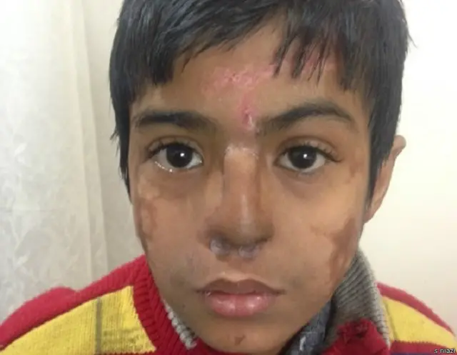 بچپن میں نیومویہ ہونے سے ارن کے ناک کو کافی نقصان پہنچا تھا