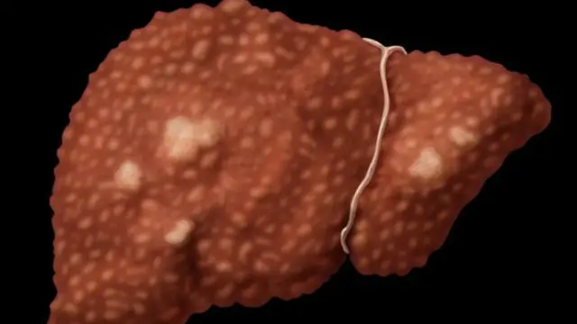 جرنل سے شائع ہونے والی رپورٹ کے تخمینے کے مطابق وائرل ہیپاٹائٹس سے 14 لاکھ 50 ہزار لوگ انتقال کر گئے تھے