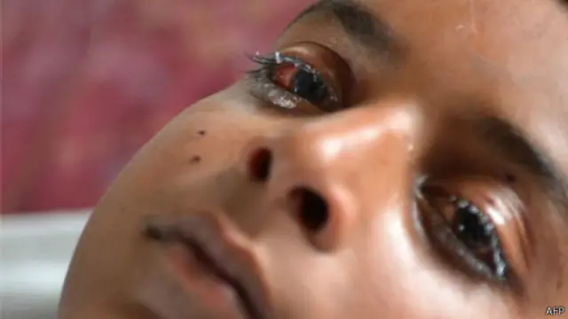 زخمی آنکھیں