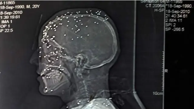 پیلیٹ گن کے کارتوس میں تقریباً پانچ سو چھرے ہوتے ہیں۔ جب کارتوس پھٹتا ہے تو چھرے ہر طرف پھیل جاتے ہیں