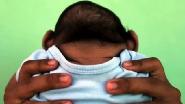 寨卡導致新生兒頭小。