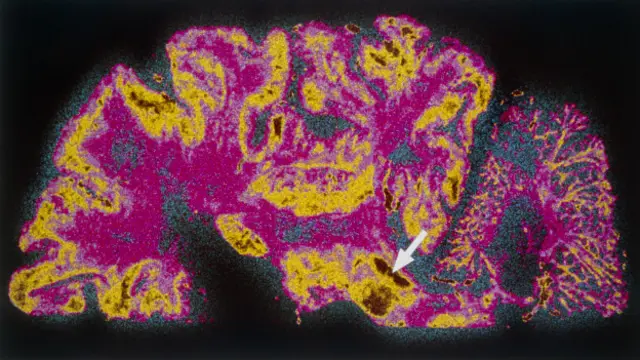 新加坡的科学家们说，他们已经创造出世界上第一个人造微型“中脑”，即人脑包括视力，听力和活动控制的部分。