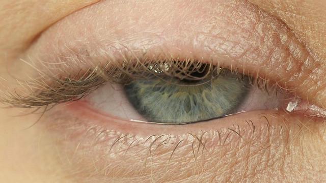 Почему вокруг глаз появляются темные круги и как это лечится?