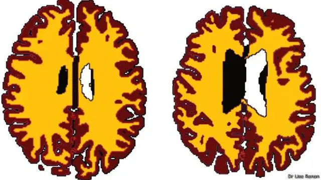 محقیقن کا کہنا ہے کہ اس تحقیق سے پتہ چلا ہے کہ کیسے اضافی وزن دماغ کو متاثر کرتا ہے