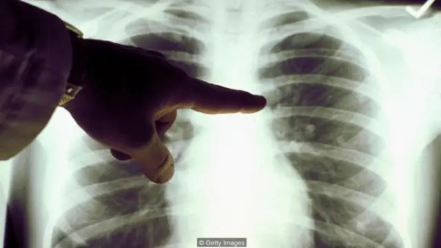 未来这种 X 光透视技术是否可以在医学上为大众服务？（图片来源：盖蒂图片社）