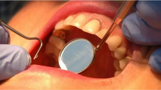 جمعية أطباء الأسنان الأمريكية دافعت بقوة عن تنظيف الأسنان بالخيط