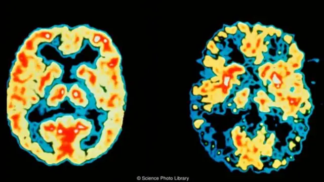 Thiếu ngủ có thể là một yếu tố góp phần đưa đến những bệnh như Alzheimer (Ảnh: Science Photo Library)